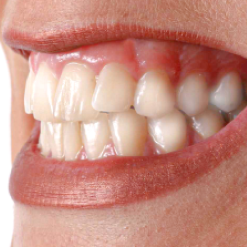 Preenchimento labial